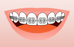 How to brush with braces