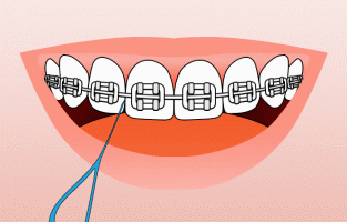 How to floss with braces